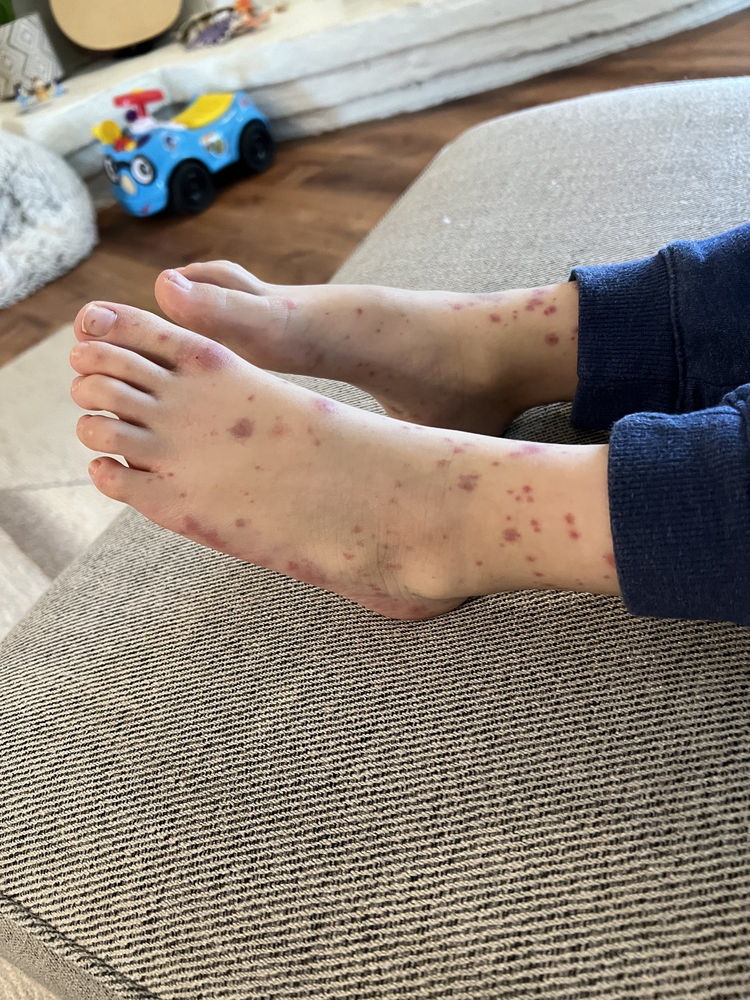 Spots that developed on Ben from HSP.